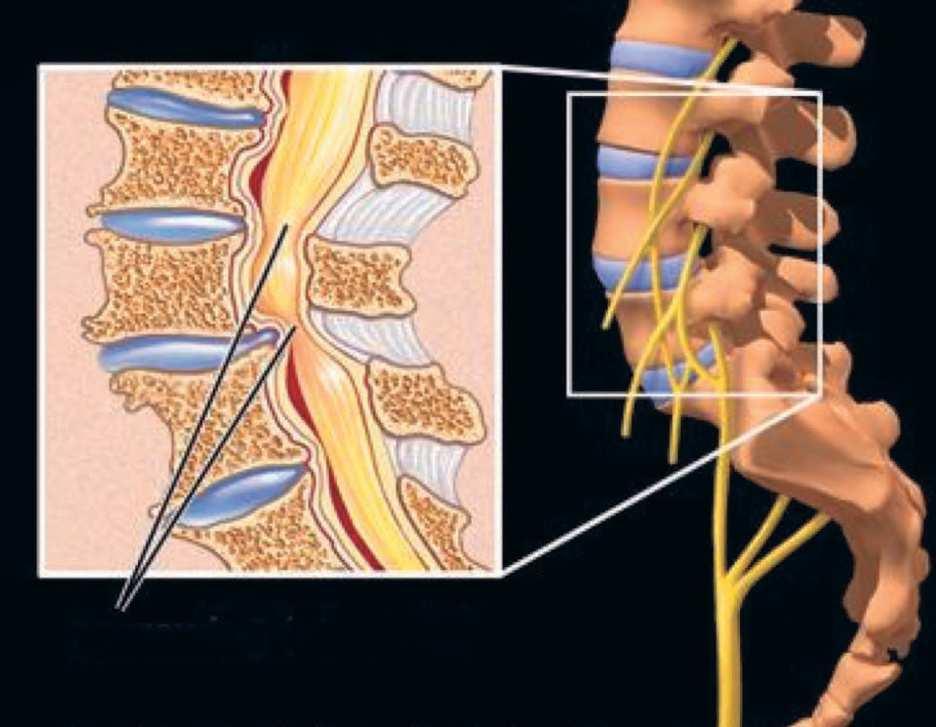 Vad innebär spinal stenos Spinal stenos betyder trängsel i ryggradskanalen. Förträngningen utvecklas med åren och diagnosen är ovanlig hos personer yngre än 45-50 år.