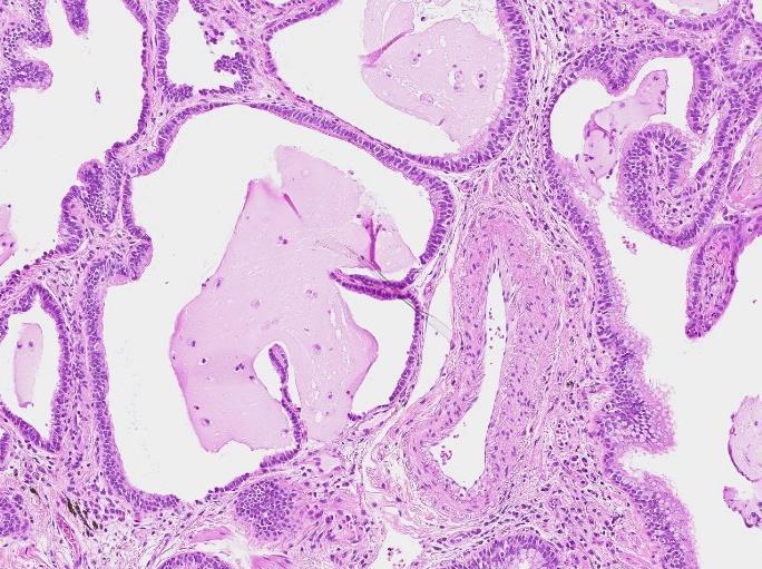 Gemensamt för båda är en diffus interstitiell kronisk inflammation, inte sällan med follikelbildning.