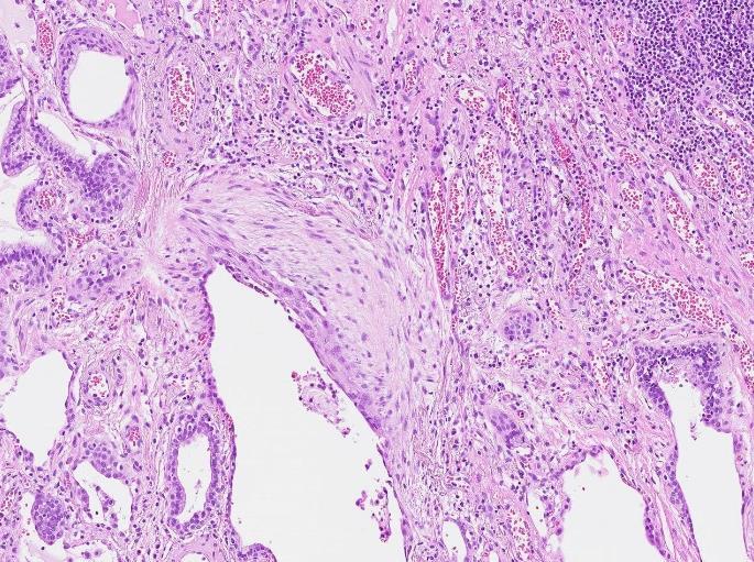 Ibland förekommer som bifynd alveolär/peribronkiolär bronkiolisering/metaplasi, osseös metaplasi, obliterativ endarterit och glattmuskelproliferation.