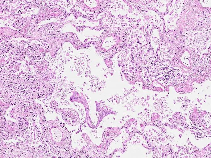 Många fall som förr klassades som LIP klassas idag som NSIP i stället, vilket har gjort diagnosen ännu ovanligare.