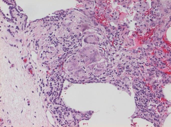 22 Dåligt formade granulom och kronisk interstitiell inflammation vid