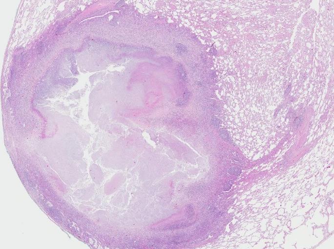 23 Eosinofil granulomatos med polyangiit (EGPA): Eosinofil granulomatos med polyangiit, tidigare kallat Churg-Strauss syndrom, är en vaskulitsjukdom (panca-positiv) som kan förekomma hos astmatiker