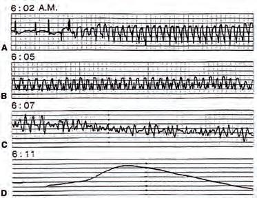 T-vector and T-loop morphology analysis 11 Abnormal myocardium with some degree of repolarization abnormalities - stable Ischemia/Reperfusion Hemodynamic, metabolic Autonomic modulation