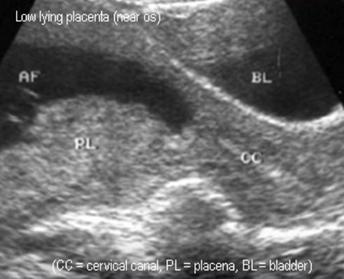 Lågt sittande placenta: Placenta sitter i nedre uterinsegmentet men täcker ej imm Ett