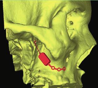 Figur 3. Tredimensionell rekonstruktion av en CT-undersökning som illustrerar hur elektroderna är införda i Fossa Pterygopalatina och att själva stimulatorn är fixerad i maxillarbenet. 4.