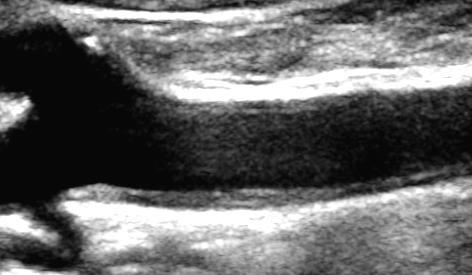 2cm distala CCA och flödesdelaren syns.