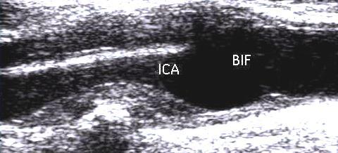 7.3.3 Tilläggsbilder över plack/stenos: 1) Rörlig sekvens i längdsnitt utan färg över plack/stenos Horisontellt kärl där plackens avgränsning syns tydligt, med största plack-arean