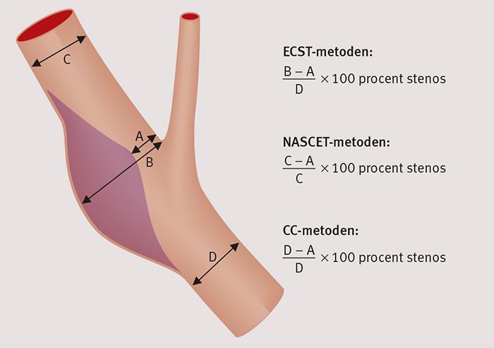 2.1.1 Indikation Fig 1. Graderingssystemen för karotisstenos. Aterosklerosens lokalisation till carotisbifurkationen gör den väl åtkomlig för undersökning med ultraljud.