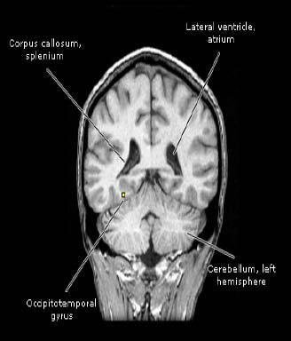 Prosopagnosia-One of most studied agnosias Damage to inferior temporal cortex, typically in right hemisphere, causes inability to identify familiar faces and sometimes inability to