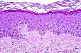 VULVA Huden Epidermis Dermis Subcutis-fettvävnad EPIDERMIS Förhornat/keratiniserat flerskiktat skivepitel. Keratinocyter.