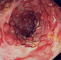 Normal colon Mb Crohn Kullerstensmönster Linjära oregelbundna sår