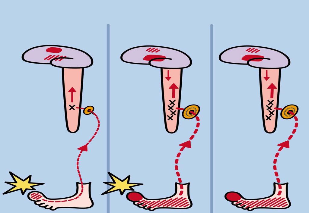 Utökad smärtbild Vilovärk eftersensation Långdragen smärta kännetecken Sensibiliseringsgrad: Vilovärk, eftersmärta, öm, hudkänslig, restless legs, fumlig,