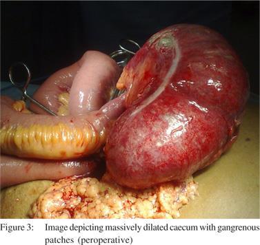 Colonileus - volvolus Caecum Diagnosen via rtg Inte sällan