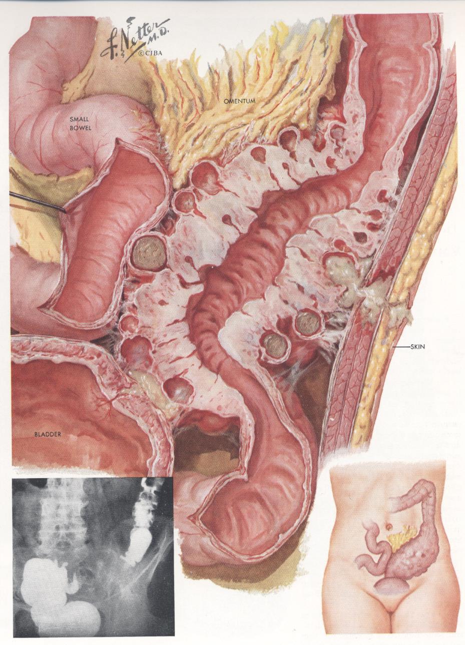 Ileus - benign (?) colonstriktur Som cancer Inflammation? Antibiotika?