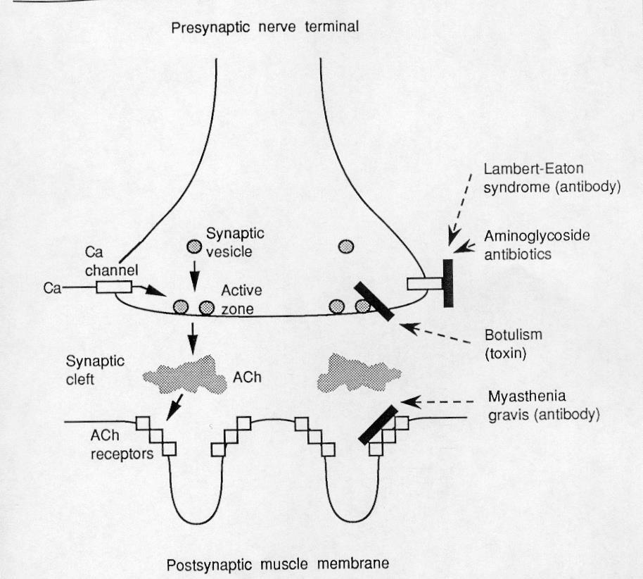 Neuromuskulära synapsen «Neuroimmunologins vagga» Myastenia Gravis Antikroppar mot Acetylkolin-receptor Ger slappa pareser Typisk uttröttbarhet Behandlas genom att hämma nedbrytning av acetylkolin