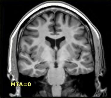 CT eller MR hjärna: visar bl.