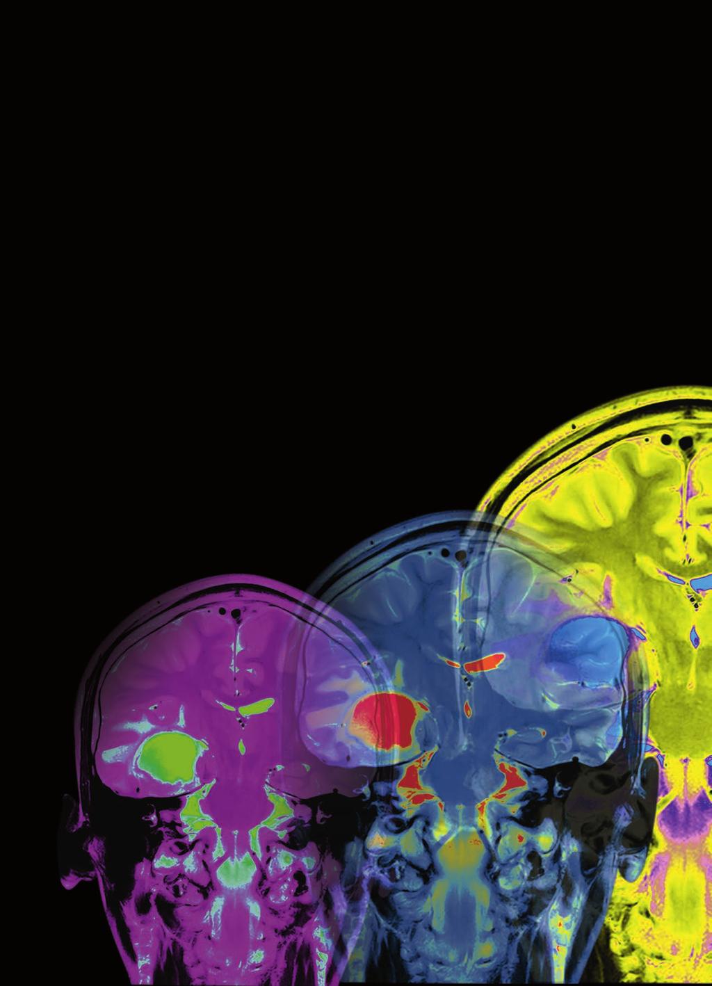 Referat Trauma Bättre prognostisering av patienter nya DT-klassificeringssystem Datortomografi av skallen är något alla patienter med traumatisk hjärnskada genomgår om man misstänker en hjärnblödning.
