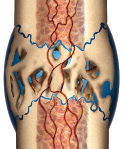 9,10 EXOGEN uppreglerar endokondral ossifi kation 11,12 och