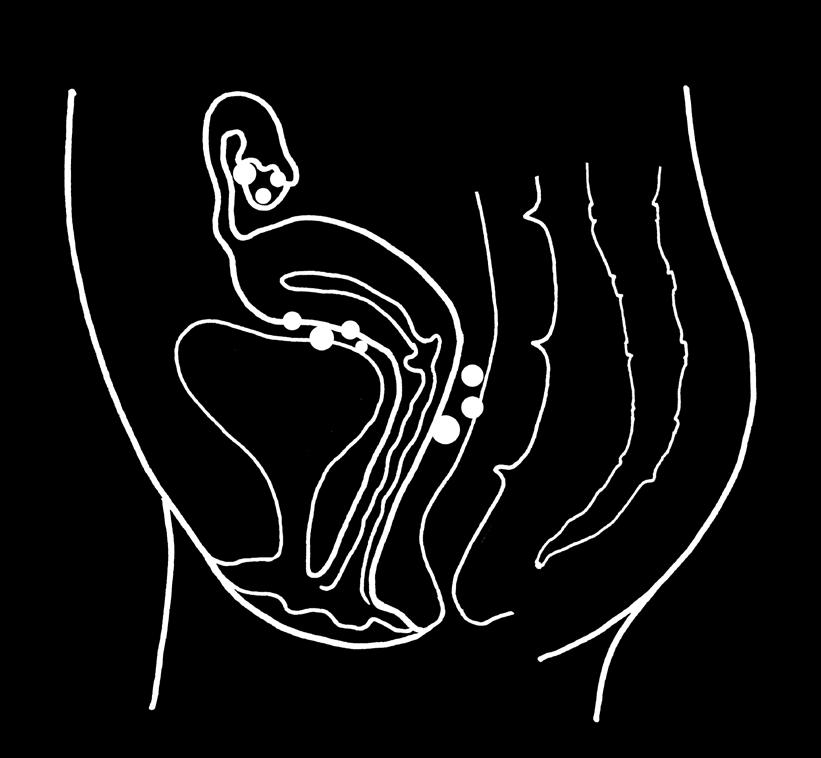 VAD ENDOMETRIOS INNEBÄR Endometrios innebär att det finns livmoderslemhinna även på andra ställen i kroppen än inuti livmodern.