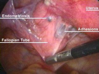 Subfertilitet / Infertilitet Mild och måttlig endometrios: