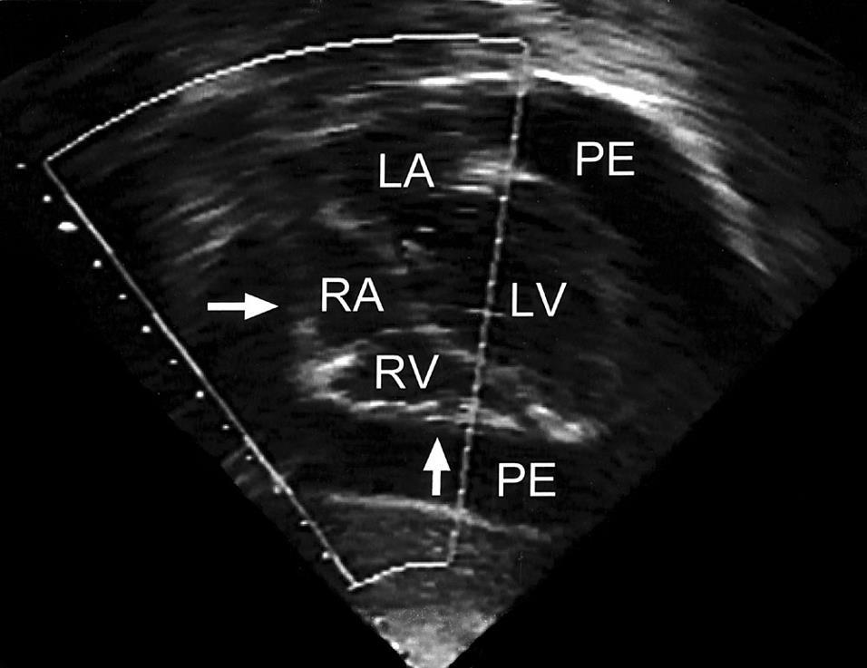 Perikardit - Tamponad Taky-, Dyspné Takykardi Hepatomegali Halsvenstas Dova hjärttoner