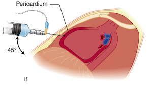 Perikardit - Behandling NSAID