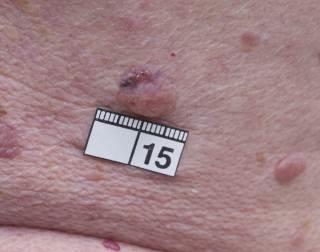 åren. För 13 år sedan opererad för 2 st in situ-melanom. Vid den senaste kontrollen hos hudläkare noteras denna förändrade lesion.