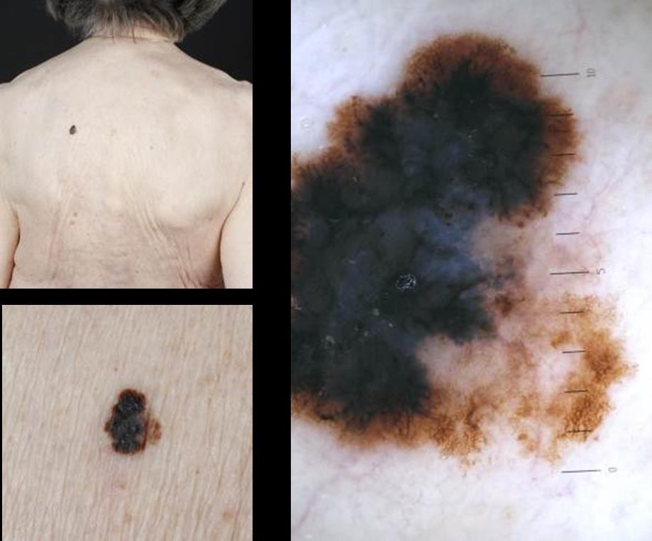 Fall 17. 91-årig kvinna söker för misstänkt pigmenterad lesion på ryggen. Inga andra pigmenterade hudförändringar syns på ryggen. PAD visar SSM-melanom, 0,7 mm tjocklek.