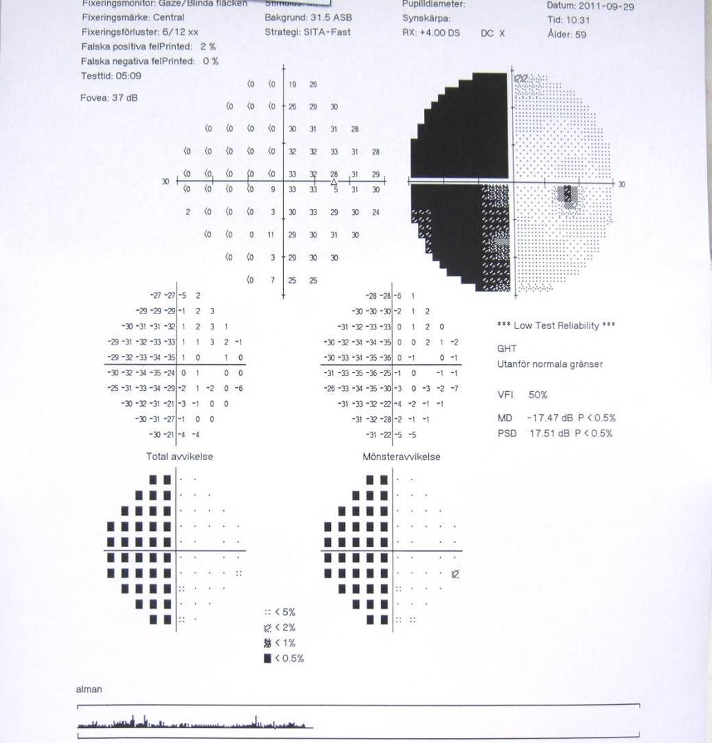 infarkt