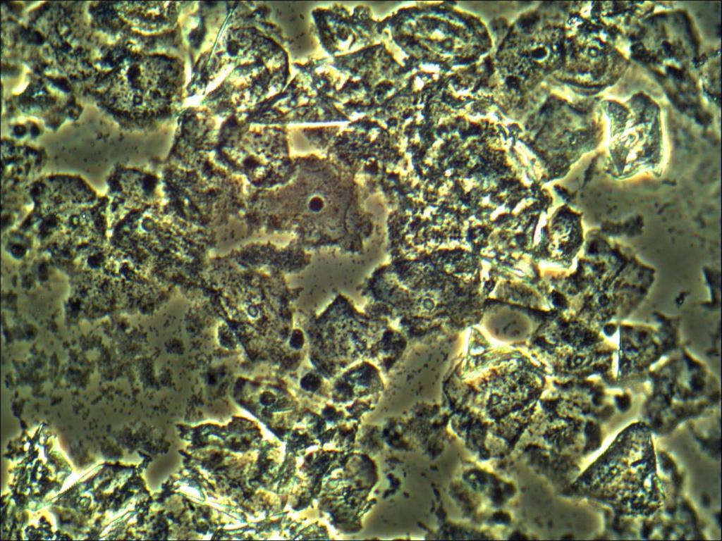 Behandling Dalacin (Clindamycin): Kräm 1 v är effektivare än vagit 3 d Donaxyl