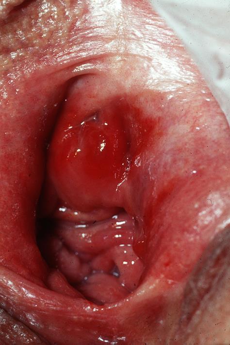 Vulvovaginit (aerobisk) Missfärgad