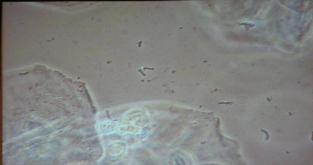 Terapiresistent/ recidiverande vulvovaginit Sällan idé att ta allmän odling Om man gör det
