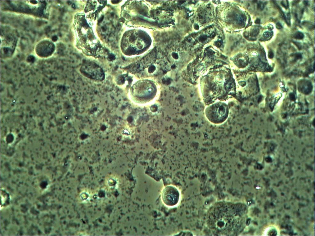 Atrofisk vaginit Behandling Dalacin +/eller Östrogen