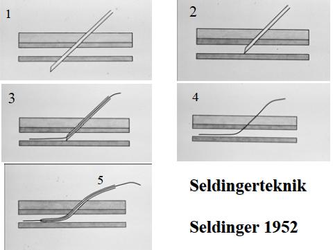 Lymfografi lymfkärl. Gjordes mycket förr men har ersatts till stor del av CT och MR. Seldinger teknik: Ett enkelt men genialt sätt att komma in i artärsystemet utan att skada kärlet.