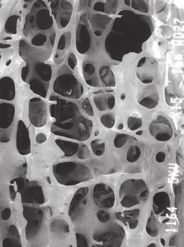 På bilderna nedan kan man se att den osteoporotiska kotan ser bräckligare ut än den normala.