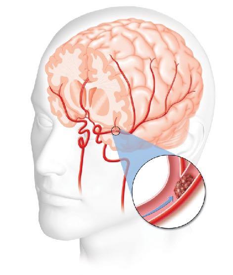 Intravenous thrombolysis