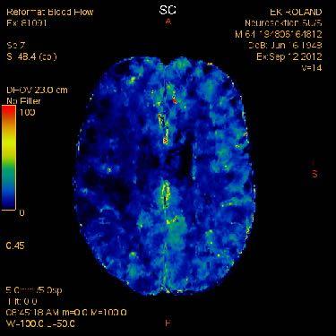 CT Perfusion Mean Transit