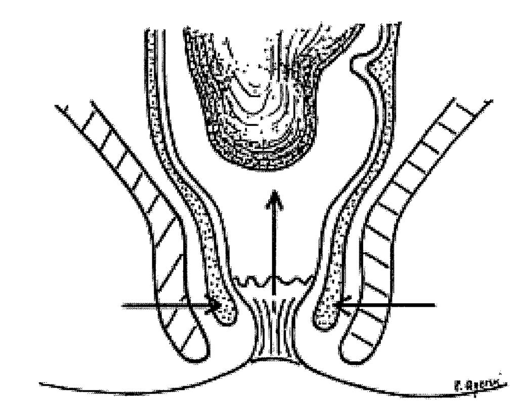 obstetric trauma. Dis Colon Rectum 1999;42:753-8; discussion 758-61. 28. Pescatori M, Pavesio R, Anastasio G, Daini S.