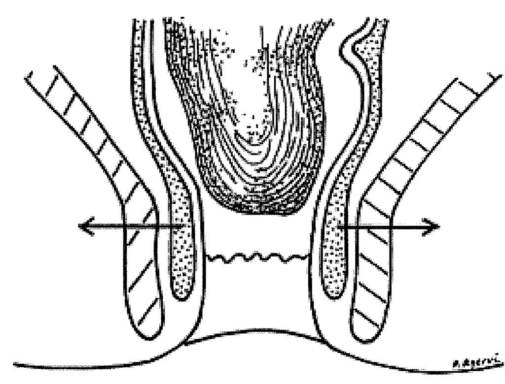 Dis Colon Rectum 1991;34:540-5. Anatomiska bilder avsedda för patientinstruktion Figur 1.