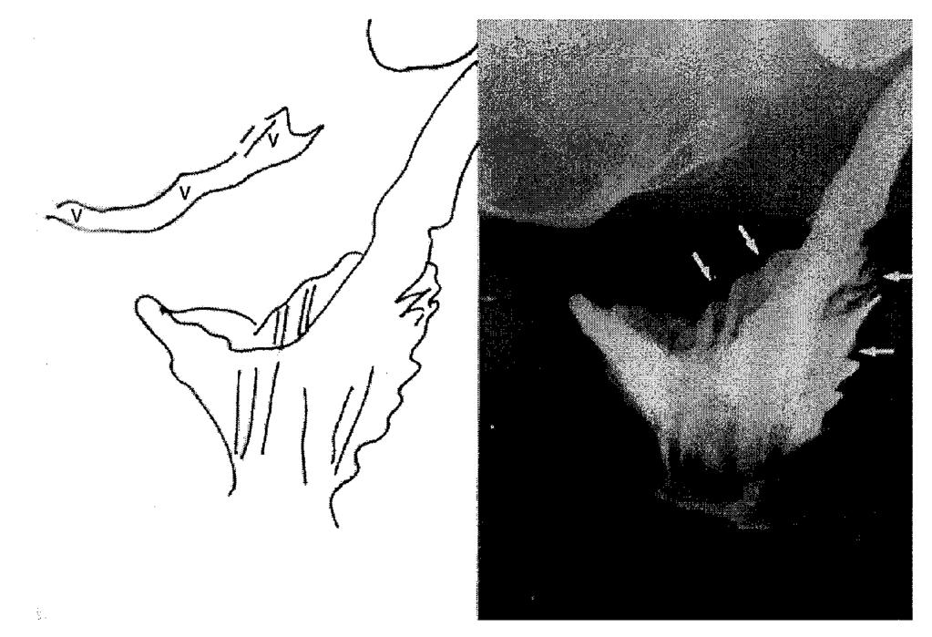 STAFFAN BREMMER Figur 1. Defekografibild till höger och förklarande skiss till vänster.