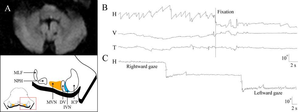 hypoglossi. Ispilesionell spontannystagmus. Normal HiT/Kalorik.