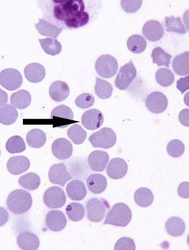 Babesios piroplasmos, sommarsjuka, (rödsjuka) Hemoglobinemi,