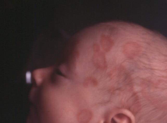 Neonatal lupus maternellt överförda anti SSA/SSB Friedman DM. Circulation 2008;117:485-493 Friedman DM.