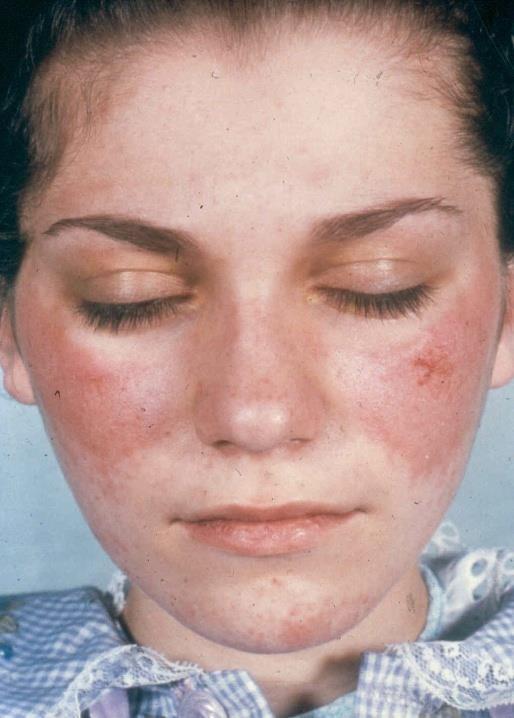 Systemisk Lupus Erytematosus (SLE) Kvinnor 15-45 år Systemsjukdom Rörelseapparaten (artriter) Hud och slemhinnor (fjärilsexantem) Blod