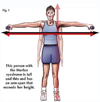 Aortadissektion/-ruptur Marfan syndrom Dominant ärftlig; 25-50% ny mutation 1:10 000