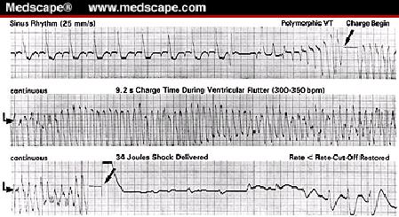 ICD - implanterbar defibrillator Hjärtscreening Hitta allvarliga sjukdomar som utgör