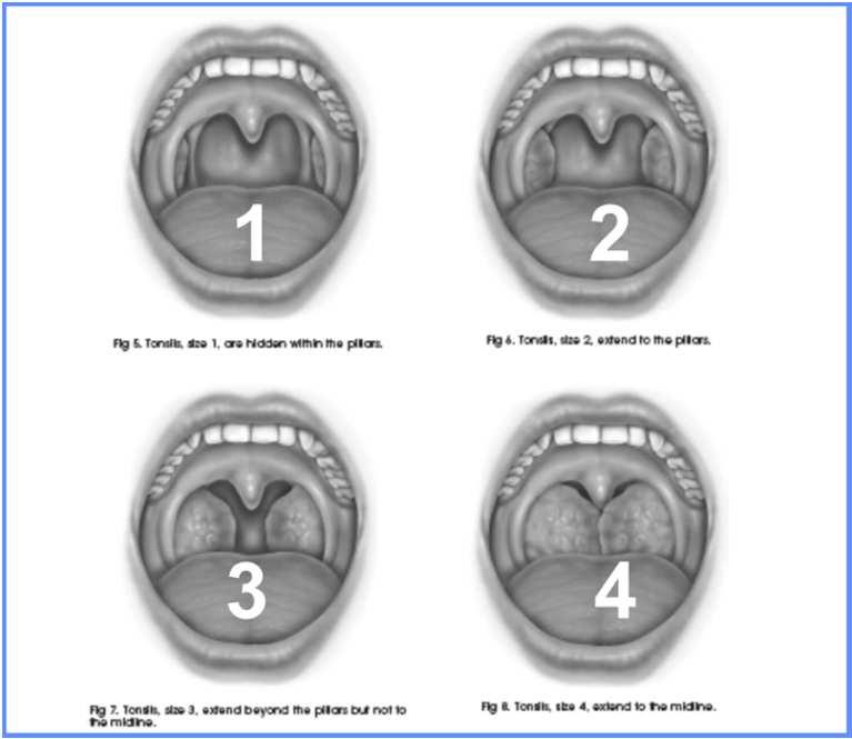 Tonsil size BMI % Stage I 1, 2 3, 4 <40 23% Stage II 1, 2 0, 1, 2 <40 22%