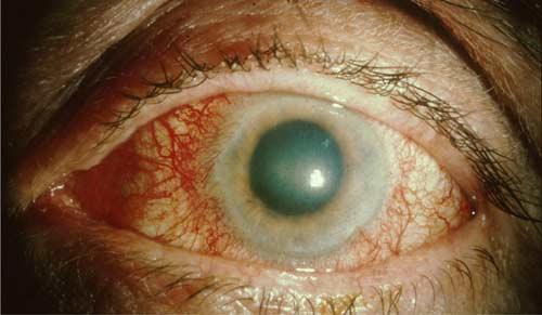Glaukom Glaukom, grön starr, är en sjukdom med ett långsamt smygande förlopp.