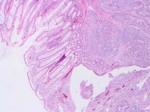 B3) En 74-årig man genomgår en biopsi av en förändring i colon som visar sig innehålla cancer. a) Ringa in cancern i bilden. b) Vilket av följande påståenden är korrekt?