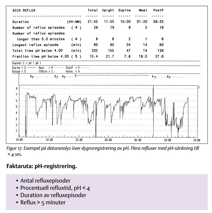 ph mätning Symptom index (SI) Andel reflux-associerade symtomepisoder Positivt test: >50% + Enkel; lätt att förstå - Tar inte hänsyn till alla reflux-episoder Symptom sensitivity index (SI) Andel